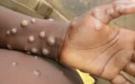 Monkeypox Case Reported In Gauteng