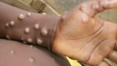 Monkeypox: US And Europe On High Alert Over Rare Viral Disease