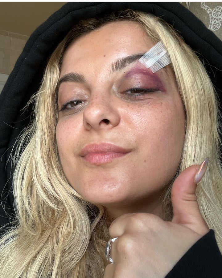 Bebe Rexha Attacked On Stage, Left With Injuries On The Face